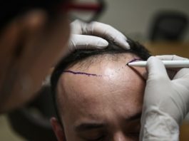 Pourquoi la greffe de cheveux et la chirurgie esthétique sont-elles moins chères en Turquie?